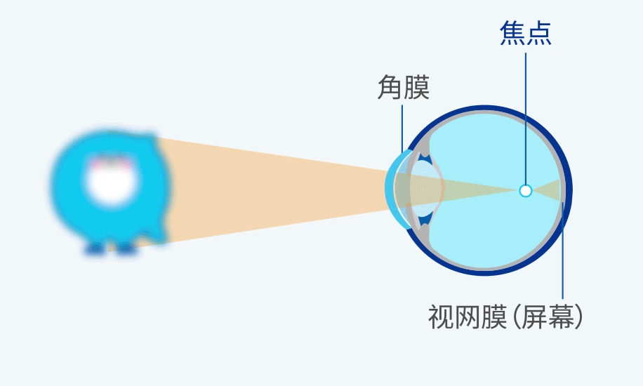 图：什么是角膜塑形术？