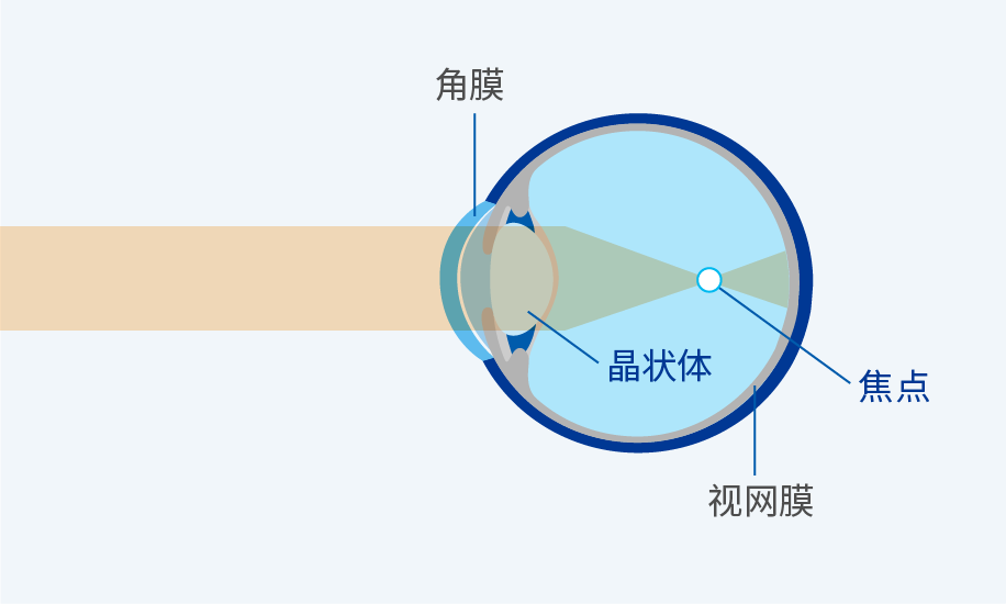图：配戴前：近视